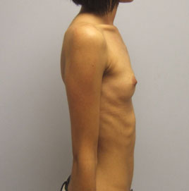 Breast Augmentation Before & After Image