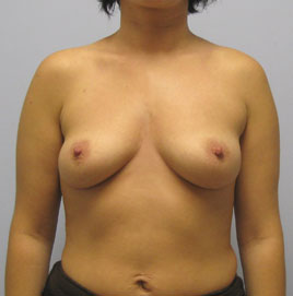 Breast Augmentation Before & After Image