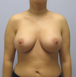 Breast Augmentation Before & After Image