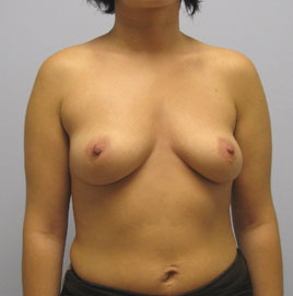 Breast Augmentation Before & After Image