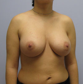 Breast Augmentation Before & After Image