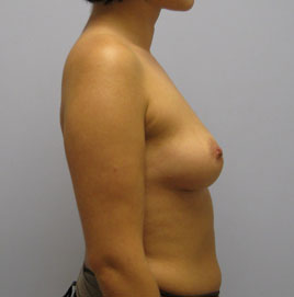 Breast Augmentation Before & After Image