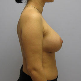 Breast Augmentation Before & After Image