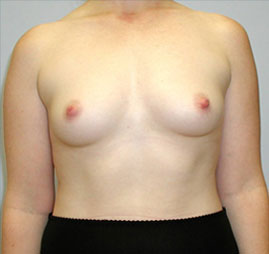 Breast Augmentation Before & After Image