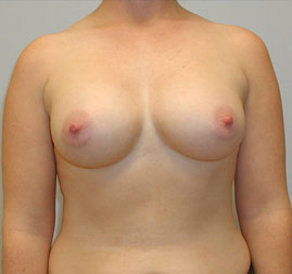 Breast Augmentation Before & After Image