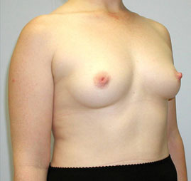 Breast Augmentation Before & After Image