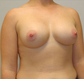 Breast Augmentation Before & After Image