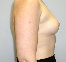 Breast Augmentation Before & After Image