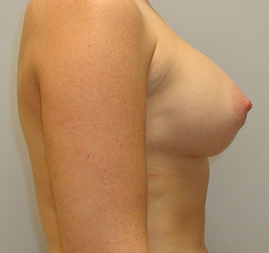 Breast Augmentation Before & After Image