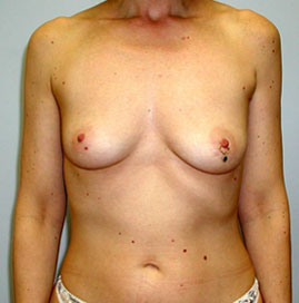 Breast Augmentation Before & After Image