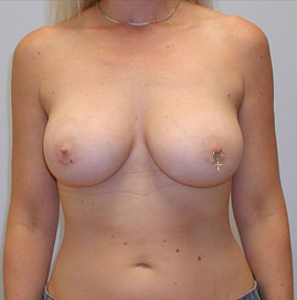 Breast Augmentation Before & After Image