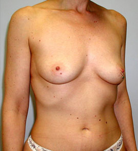 Breast Augmentation Before & After Image