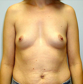 Breast Augmentation Before & After Image