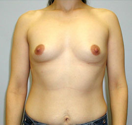 Breast Augmentation Before & After Image