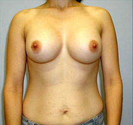 Breast Augmentation Before & After Image