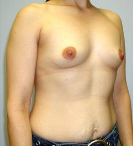 Breast Augmentation Before & After Image