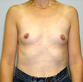 Breast Augmentation Before & After Image