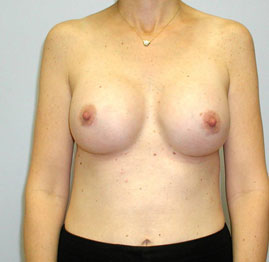 Breast Augmentation Before & After Image