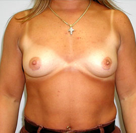 Breast Augmentation Before & After Image