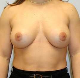 Breast Augmentation Before & After Image