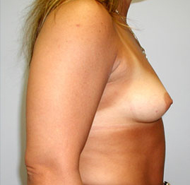 Breast Augmentation Before & After Image