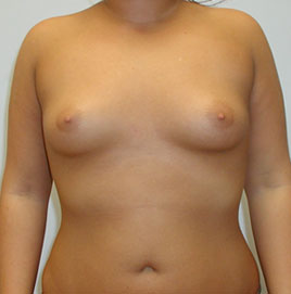 Breast Augmentation Before & After Image