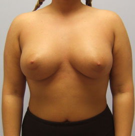 Breast Augmentation Before & After Image