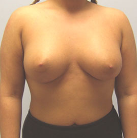 Breast Augmentation Before & After Image