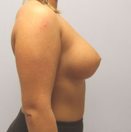 Breast Augmentation Before & After Image