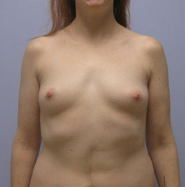 Breast Augmentation Before & After Image