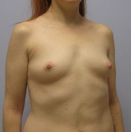 Breast Augmentation Before & After Image