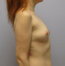 Breast Augmentation Before & After Image