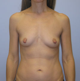 Breast Augmentation Before & After Image