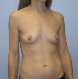 Breast Augmentation Before & After Image