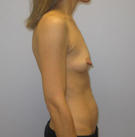 Breast Augmentation Before & After Image