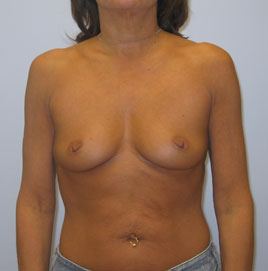 Breast Augmentation Before & After Image