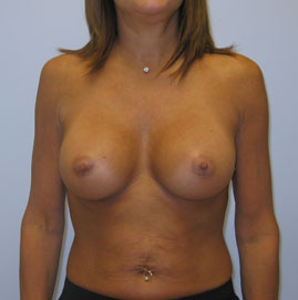 Breast Augmentation Before & After Image