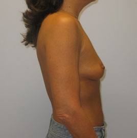 Breast Augmentation Before & After Image