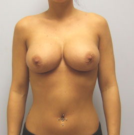 Breast Augmentation Before & After Image