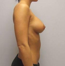 Breast Augmentation Before & After Image