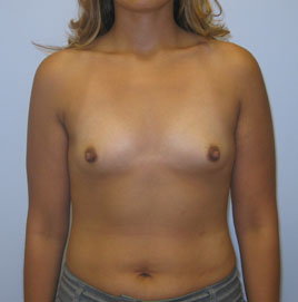 Breast Augmentation Before & After Image