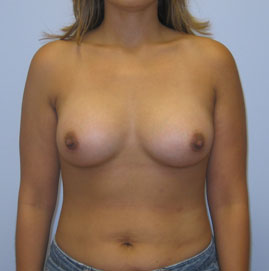 Breast Augmentation Before & After Image