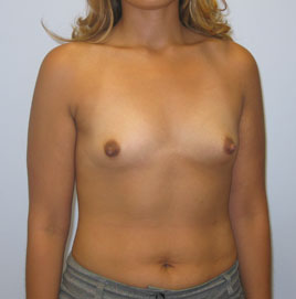 Breast Augmentation Before & After Image