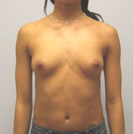 Breast Augmentation Before & After Image