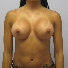 Breast Augmentation Before & After Image