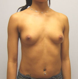 Breast Augmentation Before & After Image