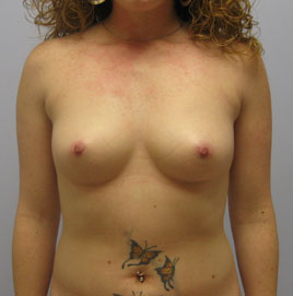 Breast Augmentation Before & After Image