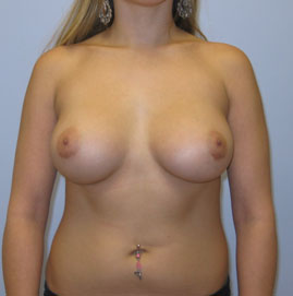 Breast Augmentation Before & After Image