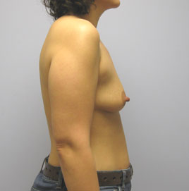 Breast Augmentation Before & After Image