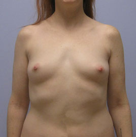 Breast Augmentation Before & After Image